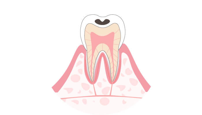 C1：エナメル質の虫歯
