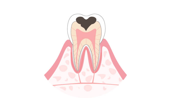 C2：象牙質の虫歯